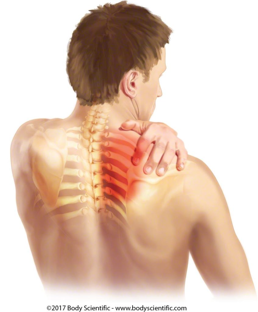 THORACIC OUTLET SYNDROME