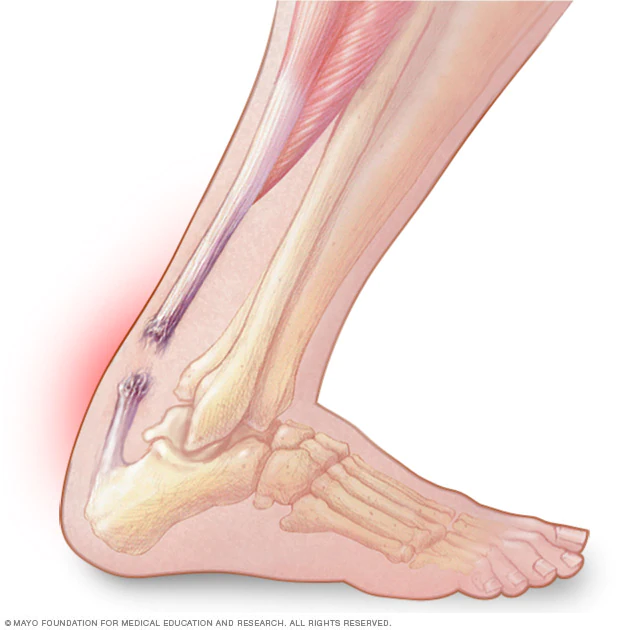 An Achilles tendon rupture