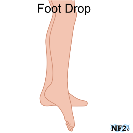 Foot drop