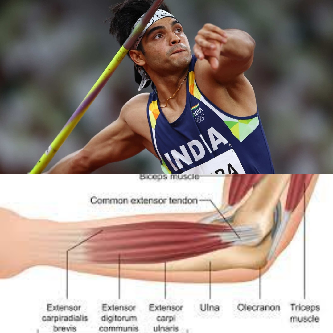 Javelin Throwers Elbow Injury